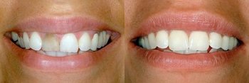 Smile Gallery - Simply Dental, Carol Stream Dentist