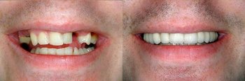 Smile Gallery - Simply Dental, Carol Stream Dentist