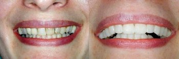Smile Gallery - Simply Dental, Carol Stream Dentist