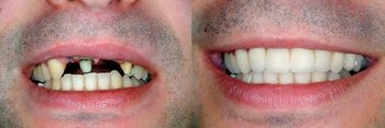 Smile Gallery - Simply Dental, Carol Stream Dentist