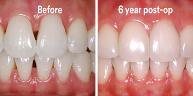 BioClear Diastema Closure and Black Triangle Closure  - Simply Dental, Carol Stream Dentist