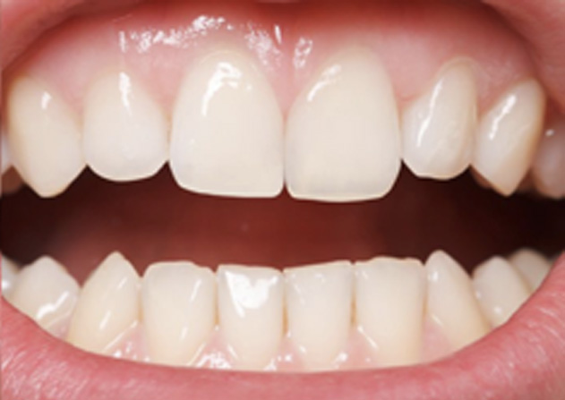 Cosmetic Bonding  - Simply Dental, Carol Stream Dentist