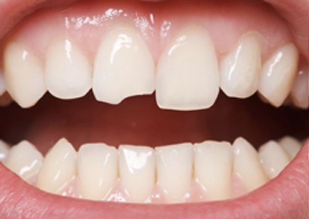 Cosmetic Bonding  - Simply Dental, Carol Stream Dentist