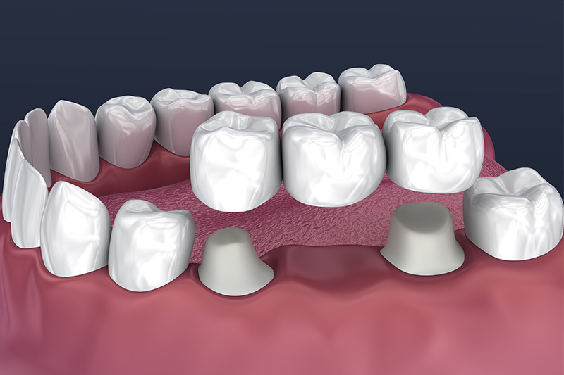 Crowns and Bridges, Inlays and Onlays  - Simply Dental, Carol Stream Dentist