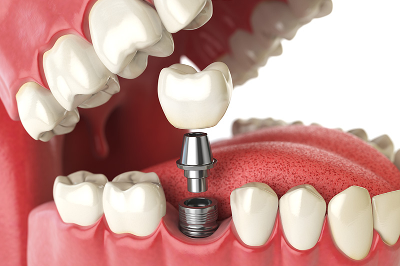 Dental Implants - Simply Dental, Carol Stream Dentist