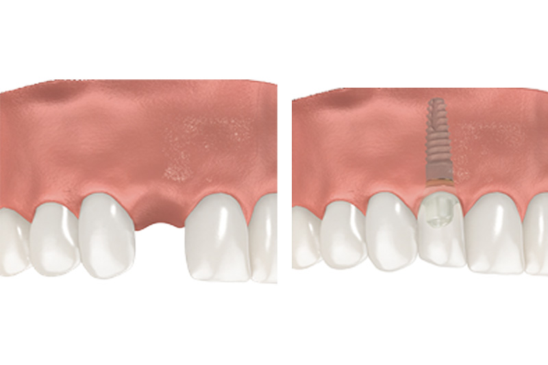 Dental Implants - Simply Dental, Carol Stream Dentist