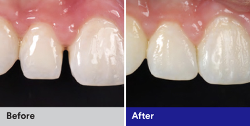 BioClear Diastema Closure and Black Triangle Closure  - Simply Dental, Carol Stream Dentist