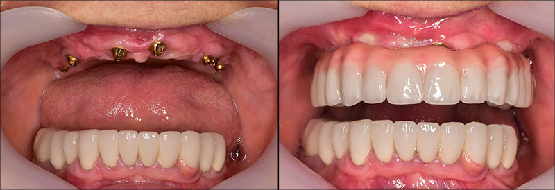Implant Overdentures and Fixed All-On-X Treatment  - Simply Dental, Carol Stream Dentist