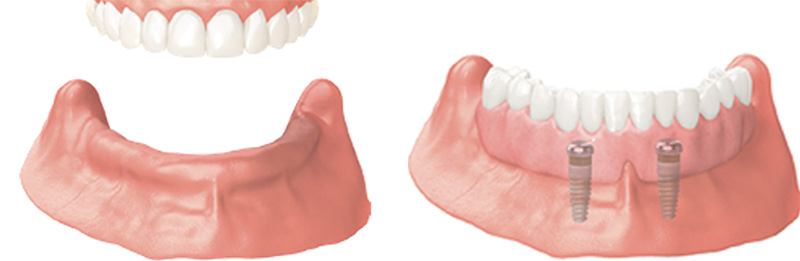 Implant Overdentures and Fixed All-On-X Treatment  - Simply Dental, Carol Stream Dentist