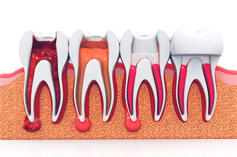 Terapia de Endodoncia  - Simply Dental, Carol Stream Dentist