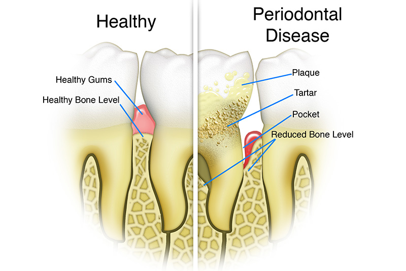 Scaling & Root Planings (Deep Cleanings)  - Simply Dental, Carol Stream Dentist