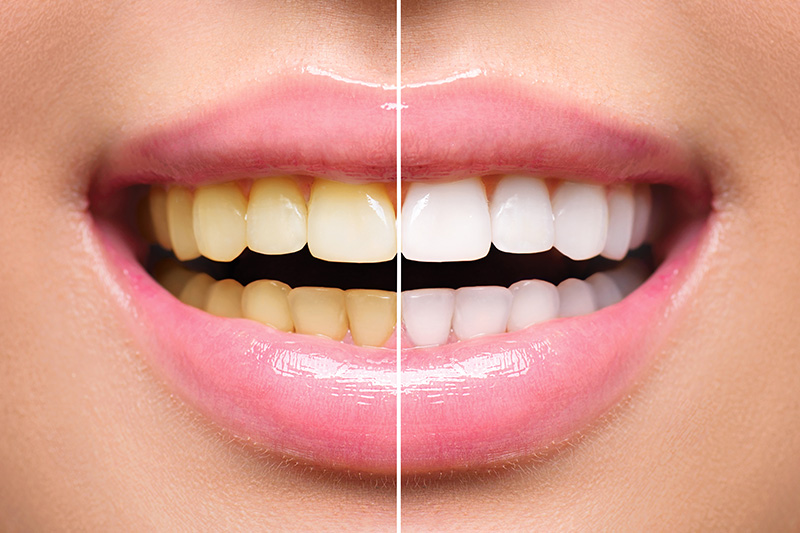 Teeth Whitening - Simply Dental, Carol Stream Dentist