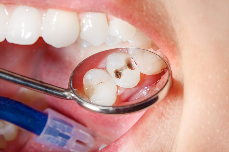 Tooth Colored Composite Fillings  - Simply Dental, Carol Stream Dentist