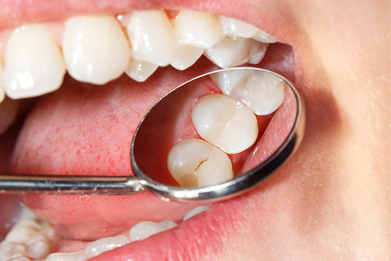 Tooth Colored Composite Fillings  - Simply Dental, Carol Stream Dentist