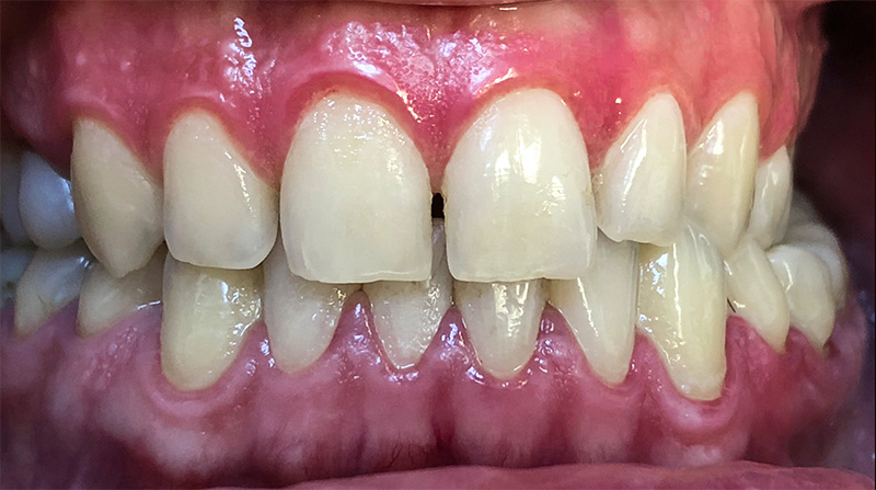 Veneers  - Simply Dental, Carol Stream Dentist