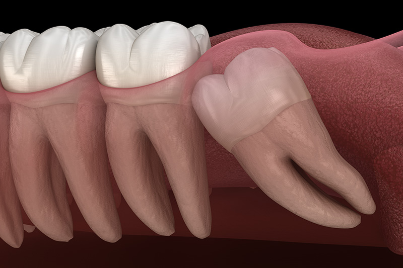 Wisdom Teeth Extractions (with Sedation)  - Simply Dental, Carol Stream Dentist